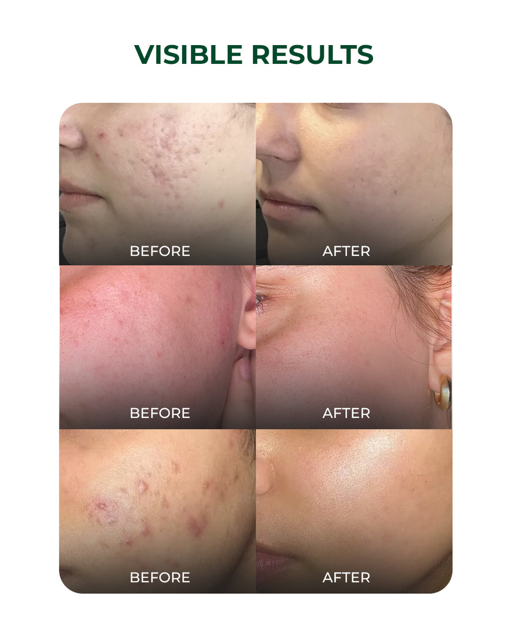 Multi-Active Discovery Kit for Acne Control, Oil Balance, and Breakout Prevention