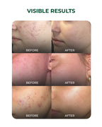 Multi-Active Discovery Kit for Acne Control, Oil Balance, and Breakout Prevention