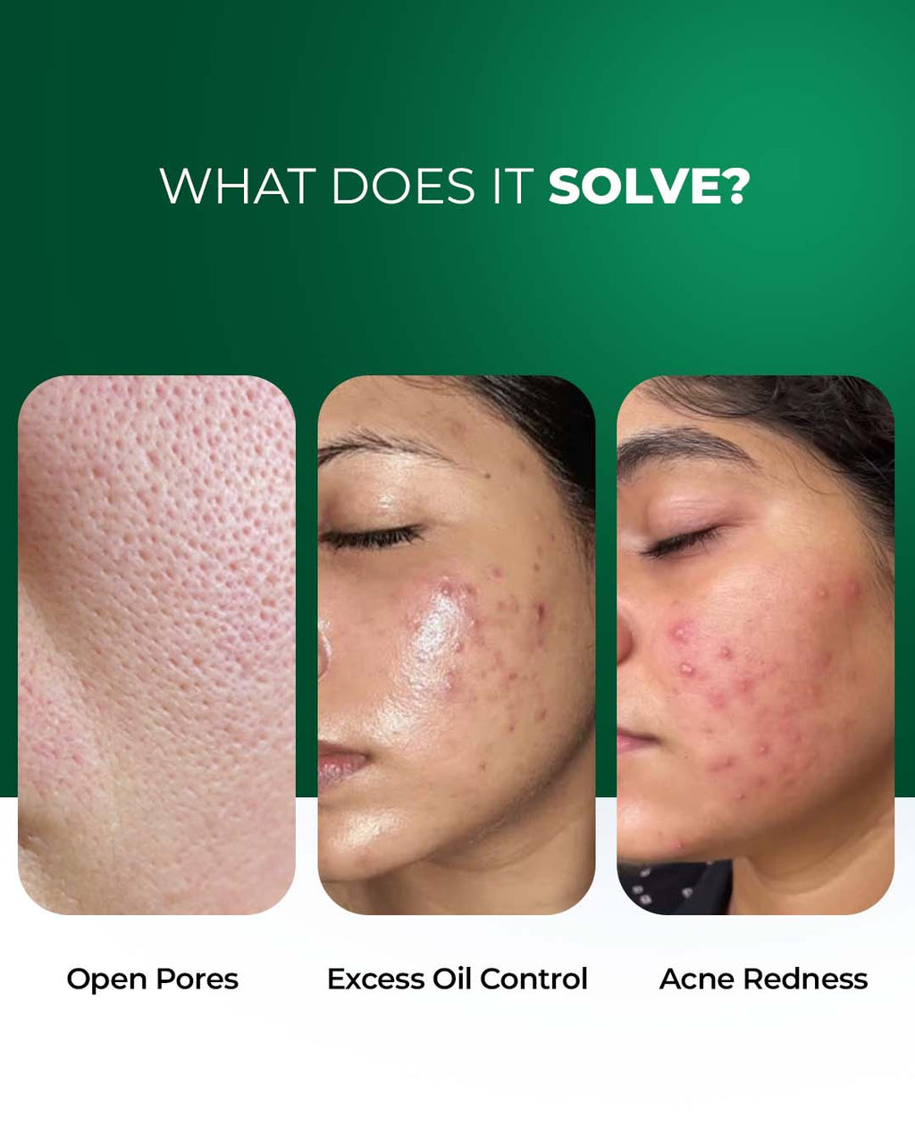 Anti Acne, Oil Control French Multi-Active Serum