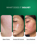 Anti Acne, Oil Control French Multi-Active Serum