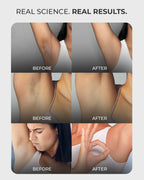 Multi-Active Underarm Treatment Roll-On | 5.5% AHA BHA | Niacinamide | Zinc Ricinoleate - French Flora Pack of 2