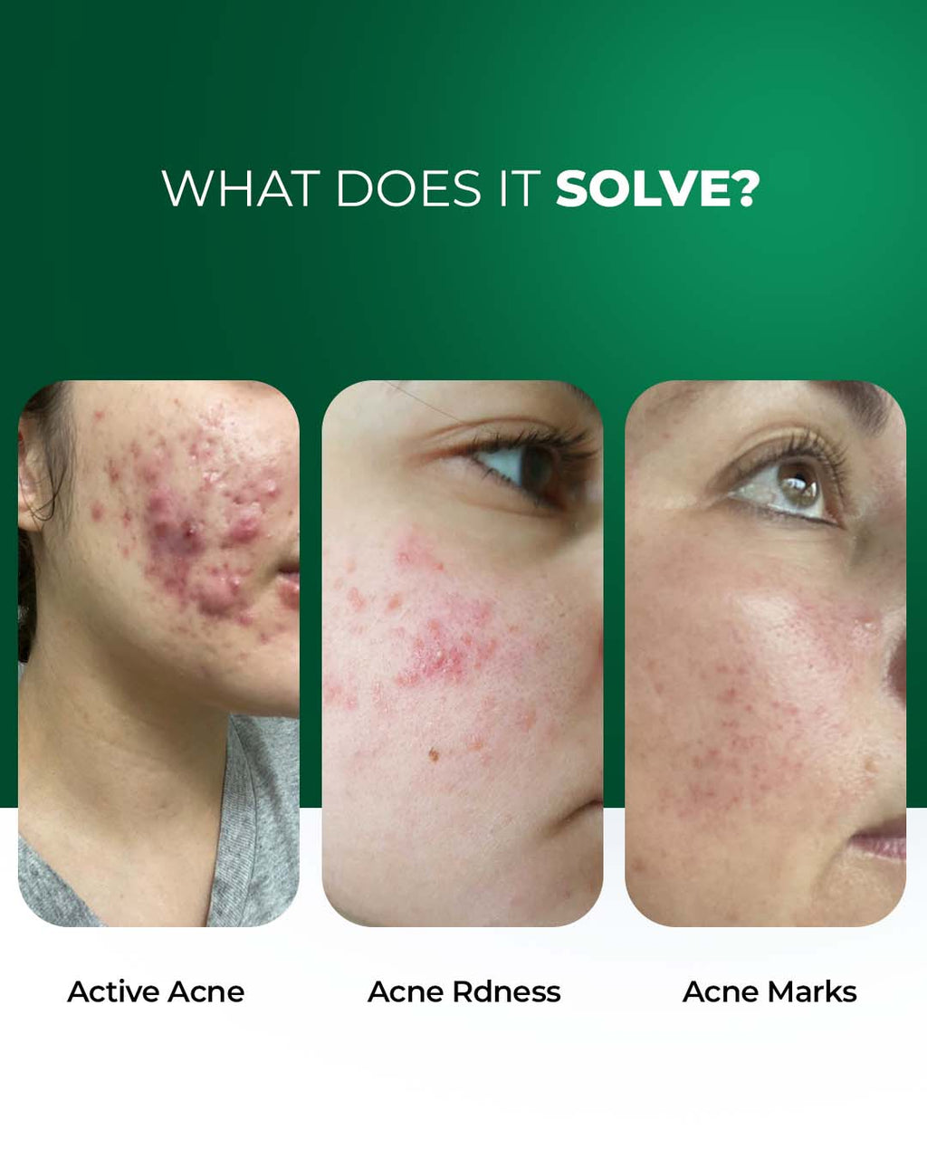 Advanced Multi-Active French Spot Corrector