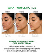 Acne Clearing Face & Body Spray with Salicylic Acid, Benzoyl Peroxide & Zinc PCA | For Back & Body Breakouts | Fast-Drying 360° Spray